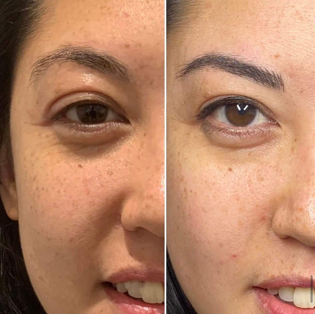 Client's brows before and after a permanent makeup treatment at Ska Brows