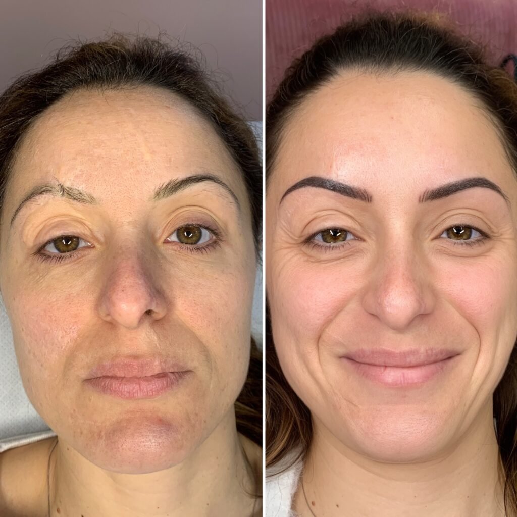 Nano Brows before and after at Ska Brows, sparse brows rebuilt into a fuller natural shape